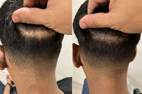 Scalp Micropigmentation in Miami for Hair Loss Solutions